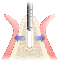 歯槽堤拡大手術（サイトダイレーティング）2