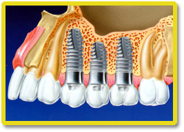 人工歯根インプラントの構造