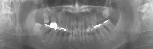 歯槽膿漏の歯槽骨