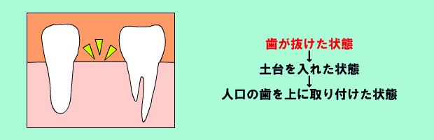 インプラント歯科治療の流れ