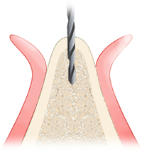 歯槽堤拡大手術（サイトダイレーティング）
