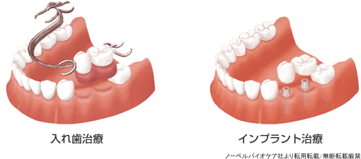 入れ歯治療と比較した利点・欠点