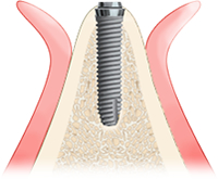 歯槽堤拡大手術（サイトダイレーティング）3